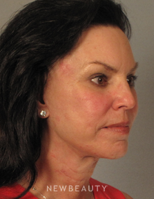 Dr. Mentz, Facelift & Necklift - After