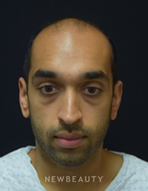 Dr. Jeffrey B. Wise - Hair Transplant - Before