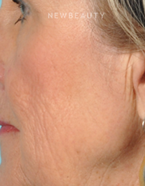 Dr. Bradley Bengtson - Skin Rejuvenation - After