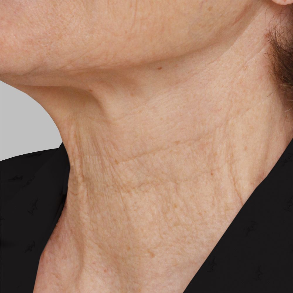 before skin-tightening treatments and Botox Cosmetic