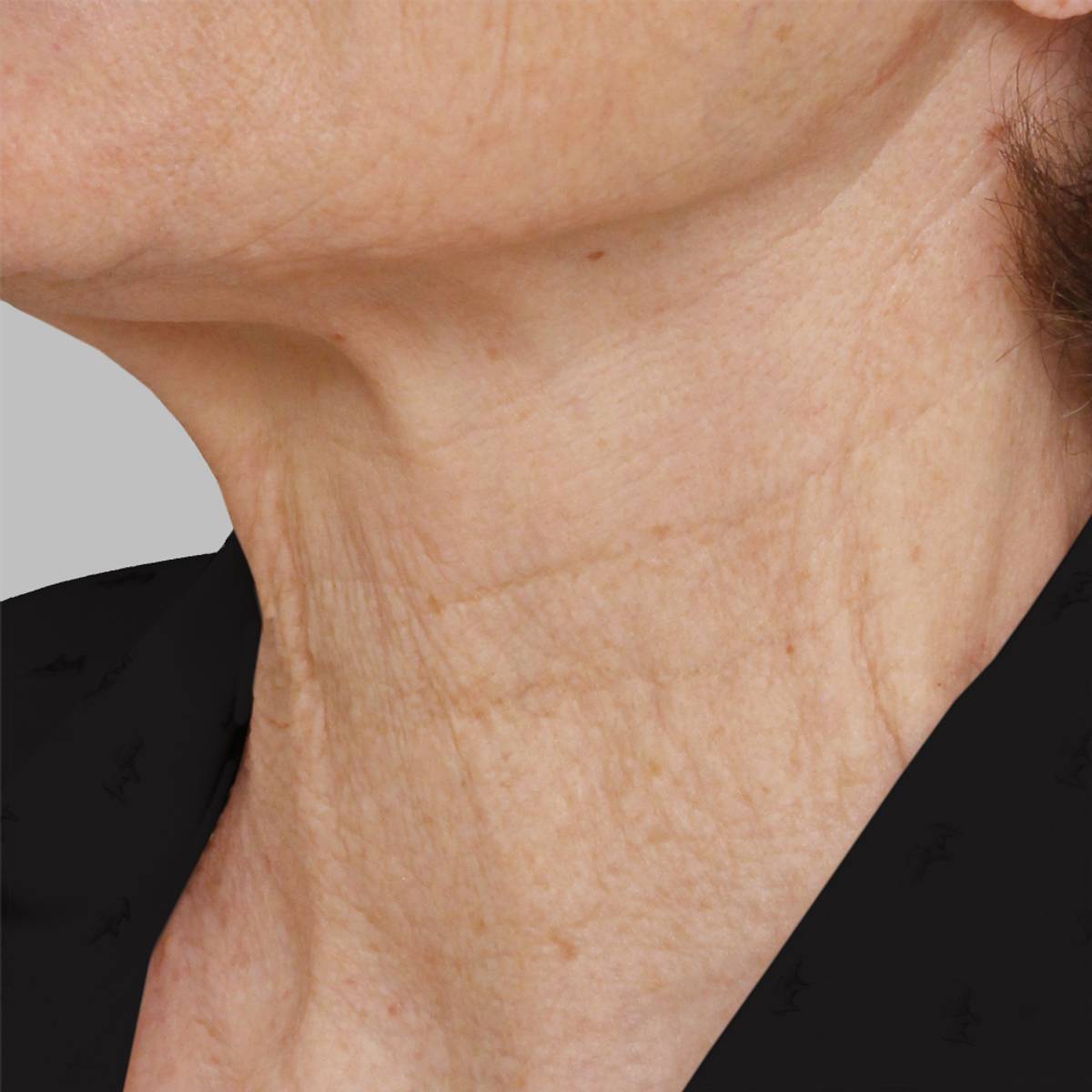 before skin-tightening treatments and Botox Cosmetic
