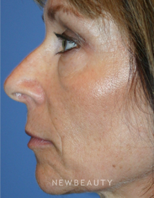 Dr. Kelly Bomer - Fillers - Before