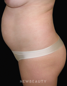 Dr. Sean Simon Laser Liposuction - Before