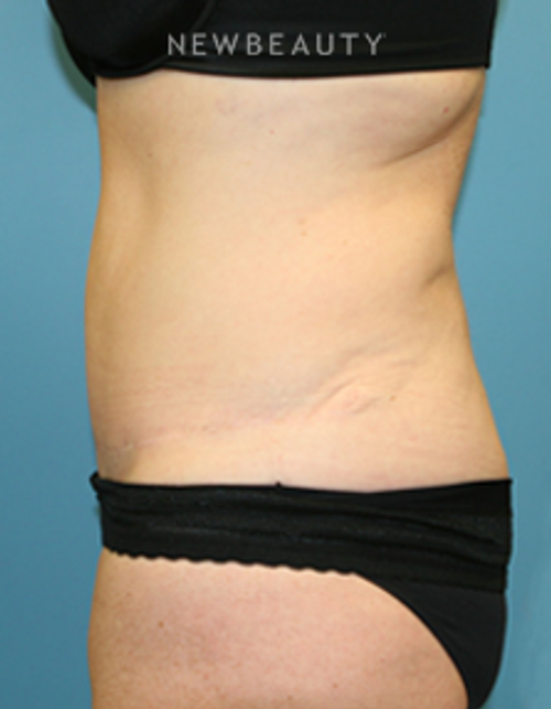 Dr. Christine Hamori - Tummy Tuck with Liposuction - After