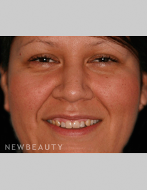 Dr. Bob Perkins Veneers - Before