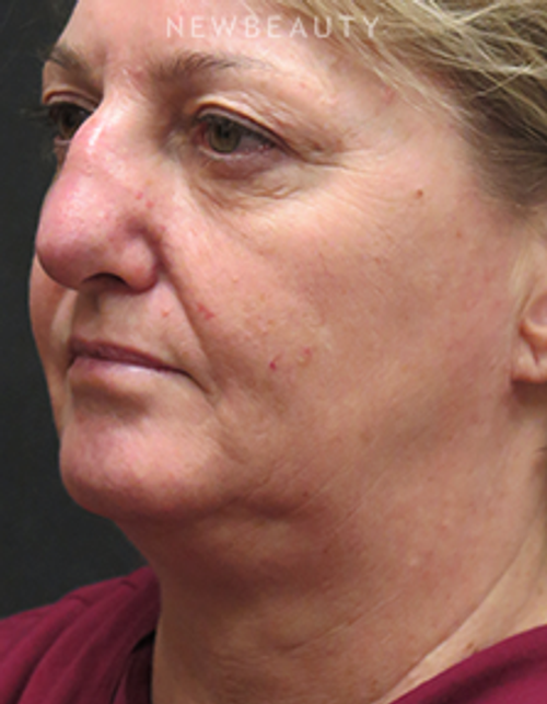Dr. Elie Levine - Necklift & Rhinoplasty - Before
