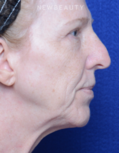 Dr. Alan Durkin - Facelift - Before
