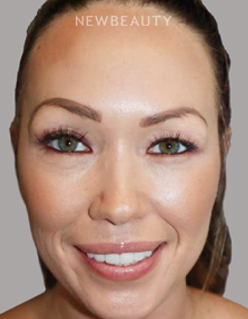 Dr. Sanjay Grover - Rhinoplasty - 49727971 - After
