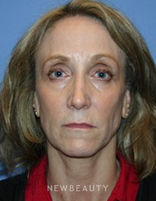 Dr. Kelly Bomer - Liquid Facelift - Before