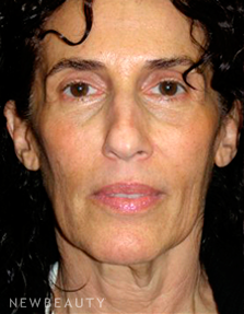 Dr. George Sanders Facelift, Chin Augmentation - Before
