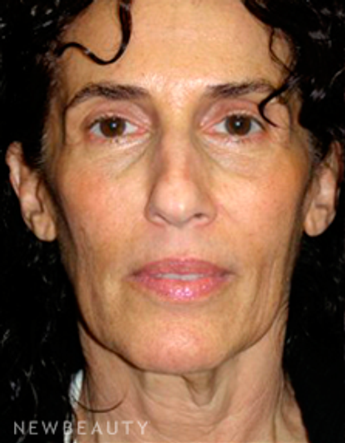 Dr. George Sanders Facelift, Chin Augmentation - Before