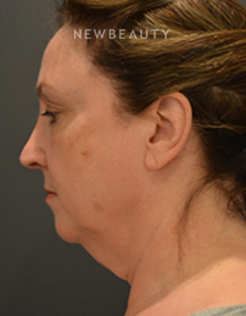 Dr. B. Aviva Preminger- Smartlipo - Before