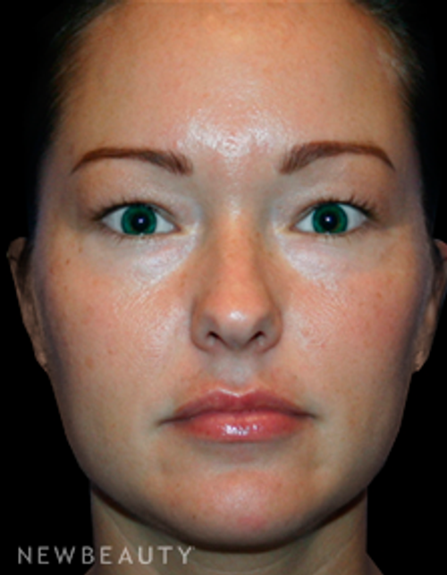 Dr. Kelly Bomer Eyelid Lift - Before