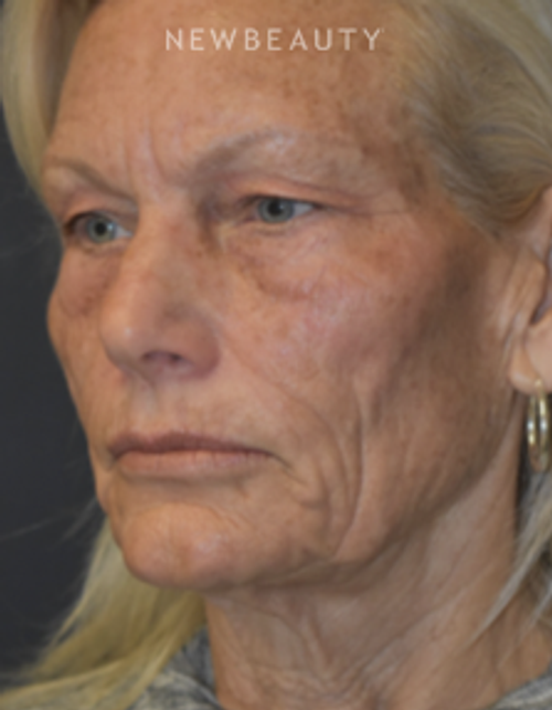 Drs. Lieberman & Parikh - Signature Facelift - Before