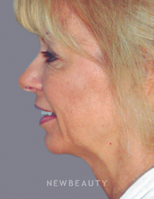 Dr. Alan Durkin Browlift, Blepharoplasty, Facelift, Liposuction - Before