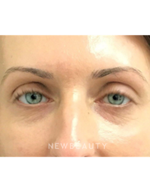 Dr. Janet Allenby - Injectables & Fillers - Before