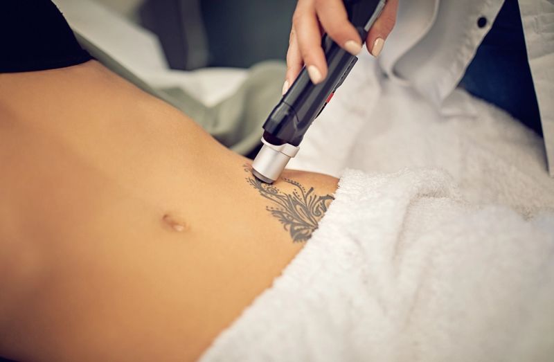 Erasing Ink: A Guide to Laser Tattoo Removal