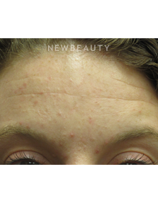 Dr. Jody Levine - Chemical Peel - Before