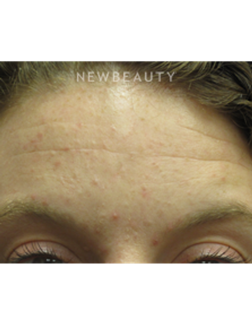 Dr. Jody Levine - Chemical Peel - Before