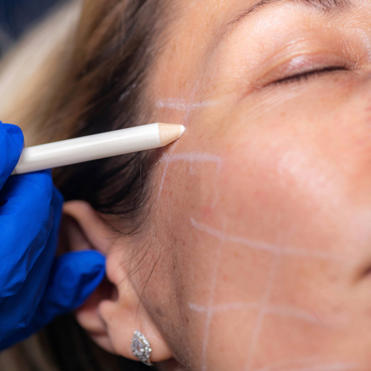 sofwave for taut neck