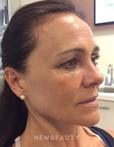 Dr. Julie Russak - Liquid Facelift - After