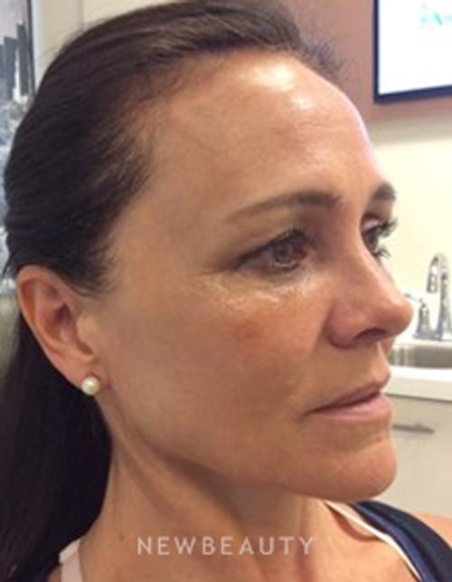 Dr. Julie Russak - Liquid Facelift - After