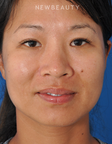 Dr. Edward Kwak - Upper Blepharoplasty - After