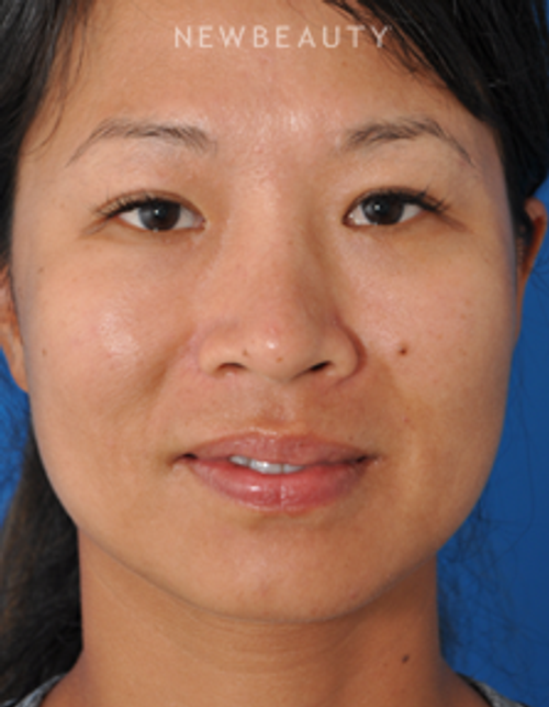 Dr. Edward Kwak - Upper Blepharoplasty - After