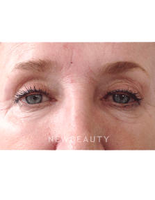 Dr. Julie Russak - Skin Tightner - Before