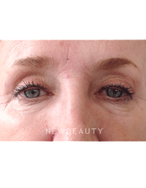 Dr. Julie Russak - Skin Tightner - Before