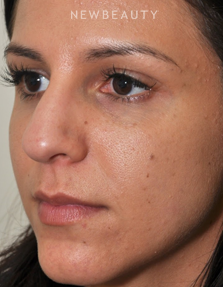 Dr. Edward Kwak - Rhinoplasty - Before
