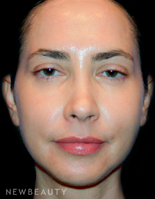 Dr. Kelly Bomer Photofacial - After
