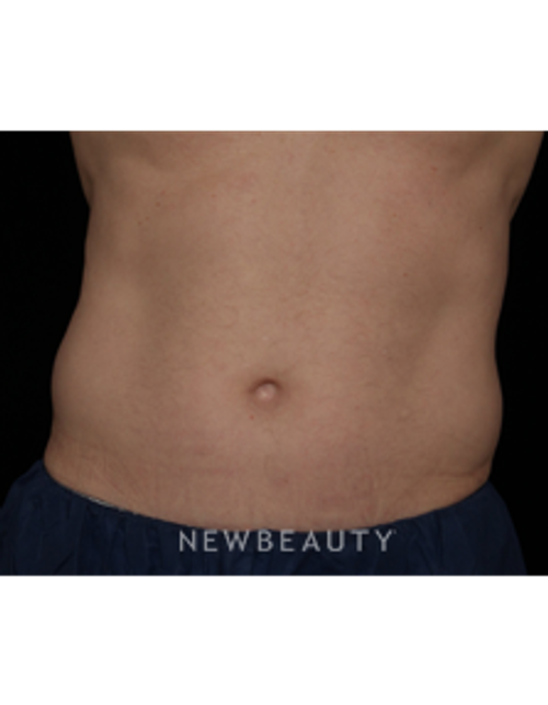 Dr. Jennifer Segal - CoolSculpting - Before
