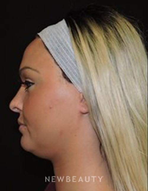Dr. Joel Schlessinger - Kybella - Before