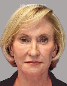 Dr. Paul Afrooz – Beautiful Transformation – 36269784 - After