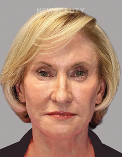 Dr. Paul Afrooz – Beautiful Transformation – 36269784 - After