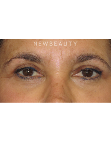 Dr. George Sanders - Eyelift - After