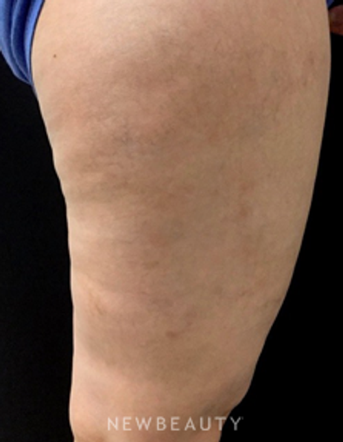 Dr. Gilly Munavalli - Spider Veins - After