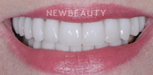 Dr. Salvator La Mastra- Smile Makeover -46107717 - After