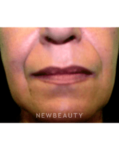 Dr. Marina Peredo Radiesse - Before
