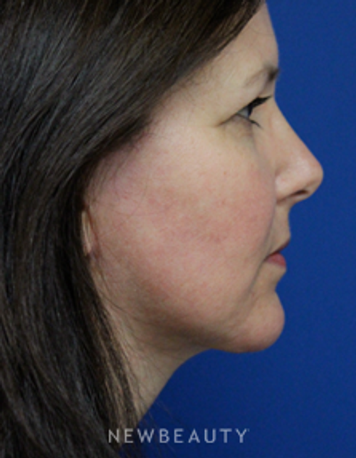 Dr. Joseph Russo - A Balanced Facial Profile - After