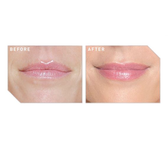 Before and after lip filler