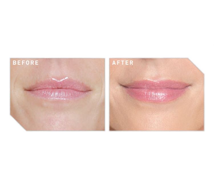 Before and after lip filler