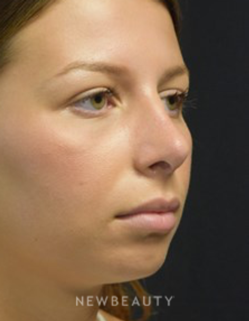 Dr. Jeffrey B. Wise - Rhinoplasty - After