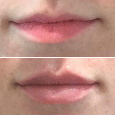 lip flip before and after using Botox and two syringes of Juvéderm