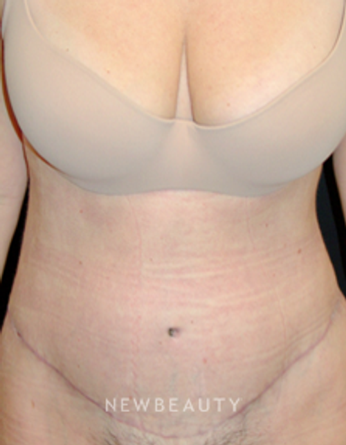 Dr. Mokhtar Asaadi Tummy Tuck, Liposuction - After