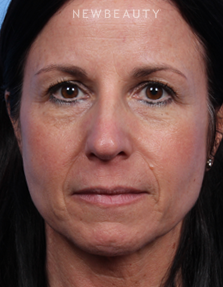 Dr. Kelly Bomer - Facelift - Before
