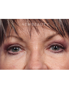 Dr. Kelly Bomer - Upper Blepharoplasty - After