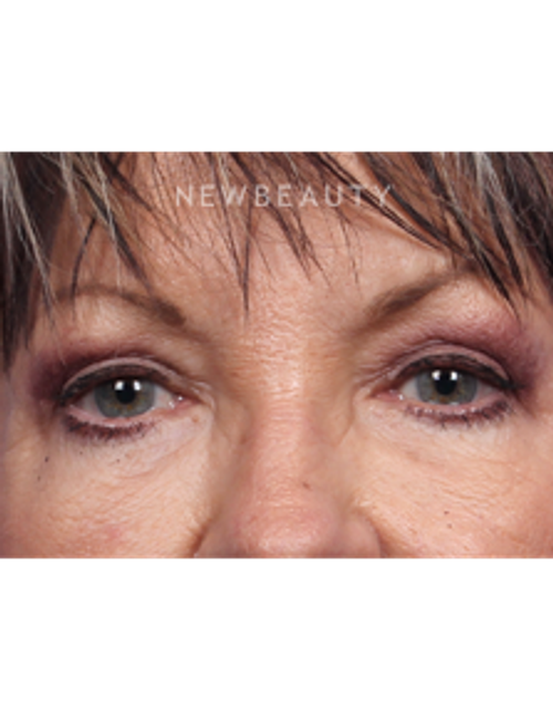 Dr. Kelly Bomer - Upper Blepharoplasty - After