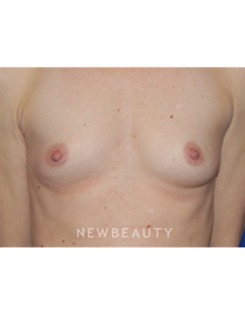 Dr. Bradley Bengtson - Breast Augmentation - Before
